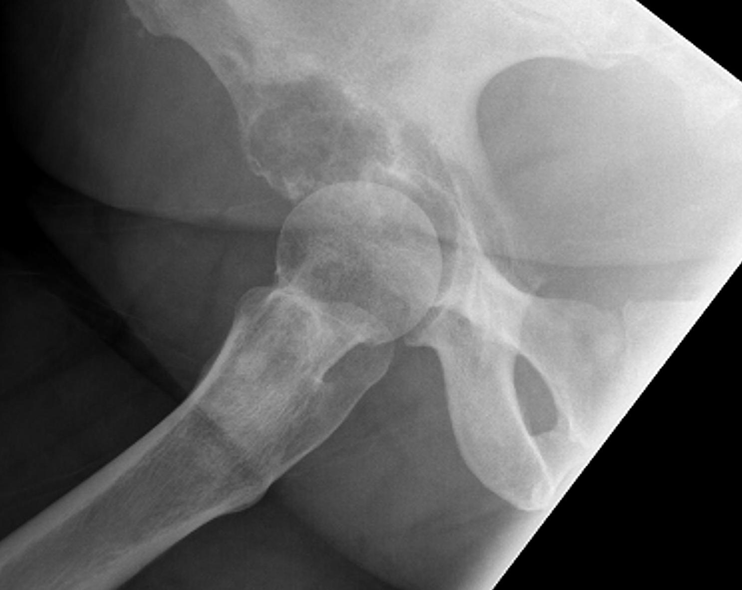 Metastasis Acetabulum Type III Lateral